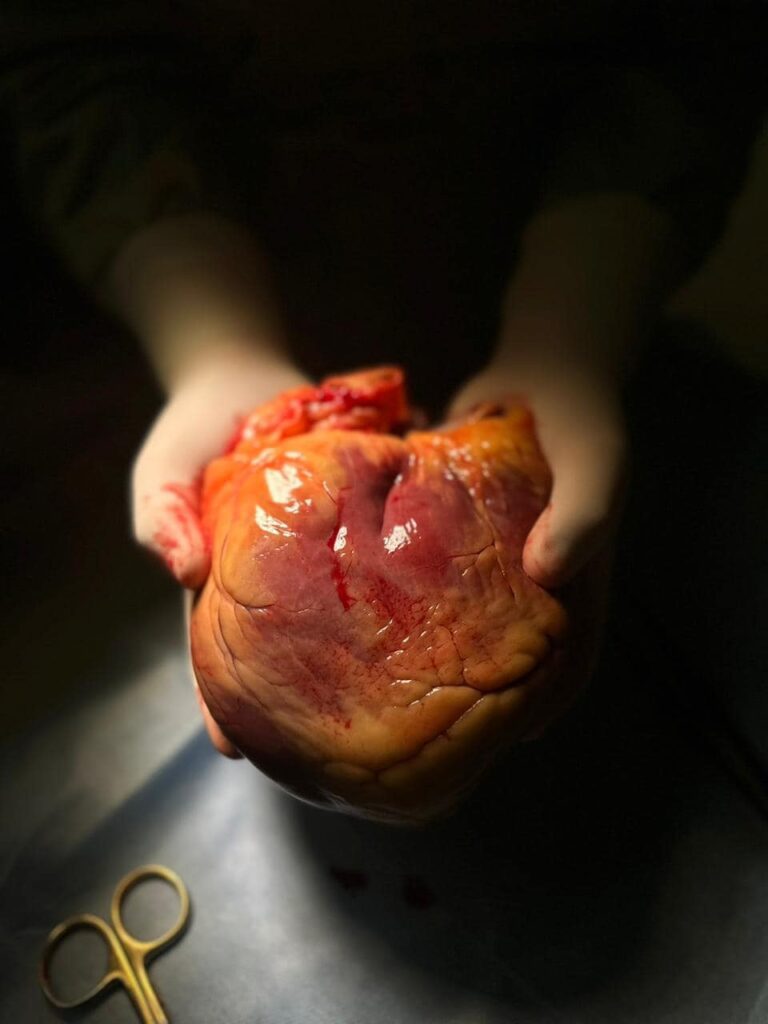 Трансплантація серця у Полтаві