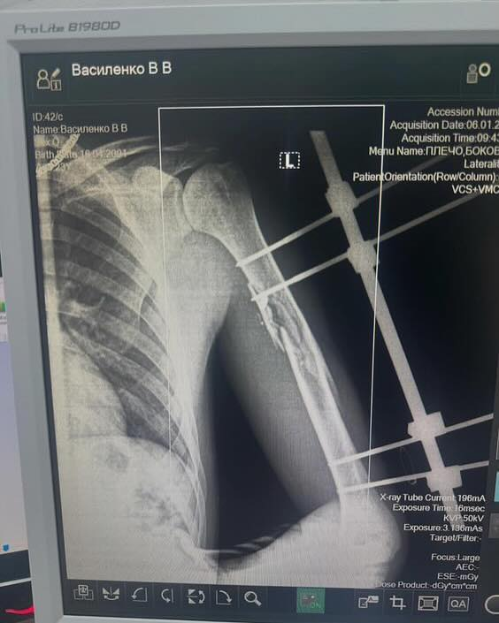 Поранений воїн Володимир Василенко