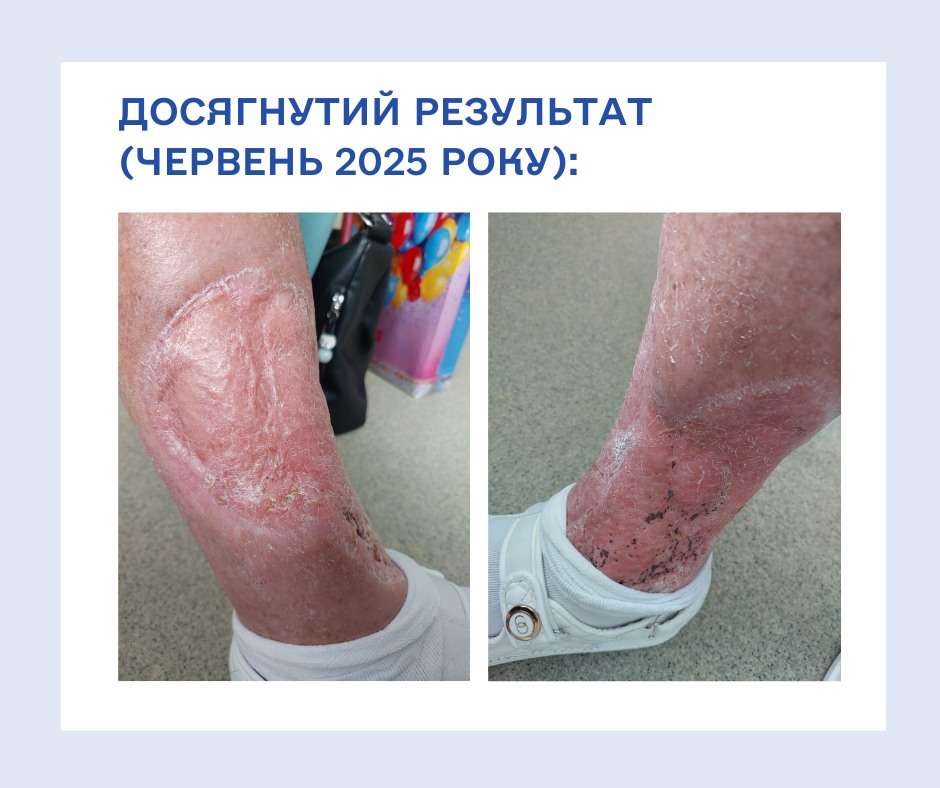 могла втратити ногу - лікарі врятували